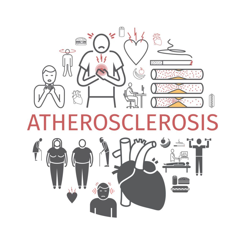 Drawing of "atherosclerosis" with people clutching their chests, highlighting the condition's impact on heart health.