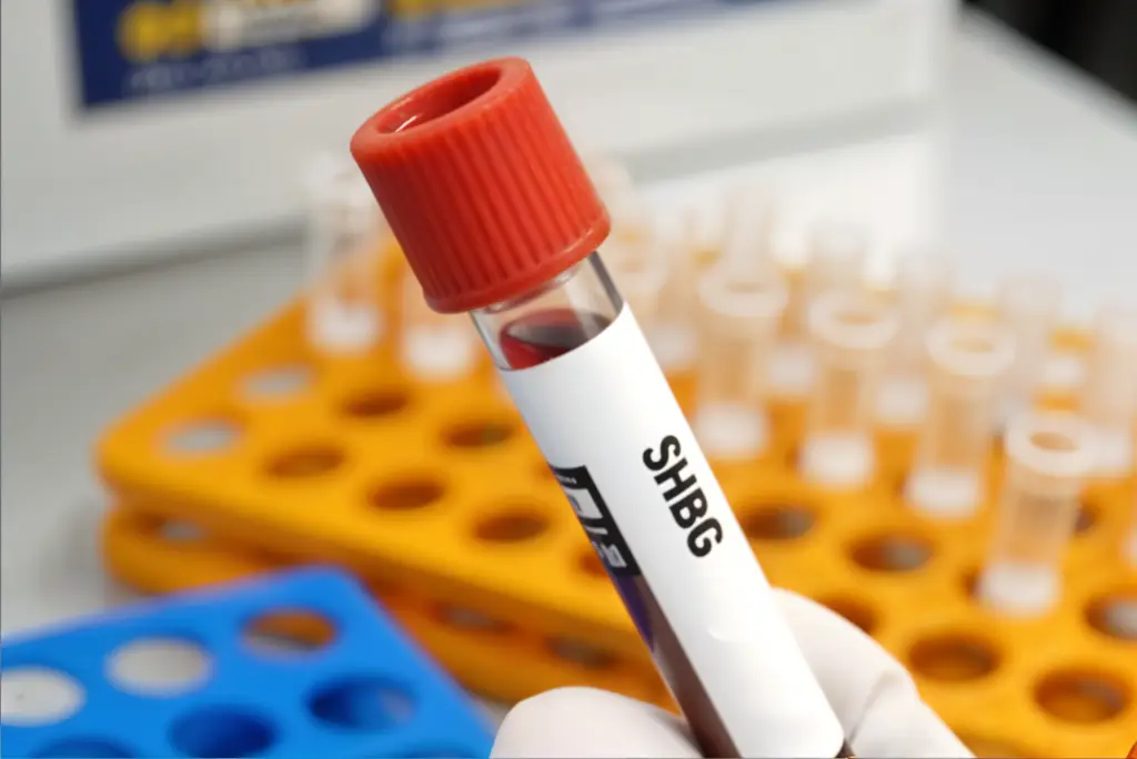 sex hormone binding globulin high