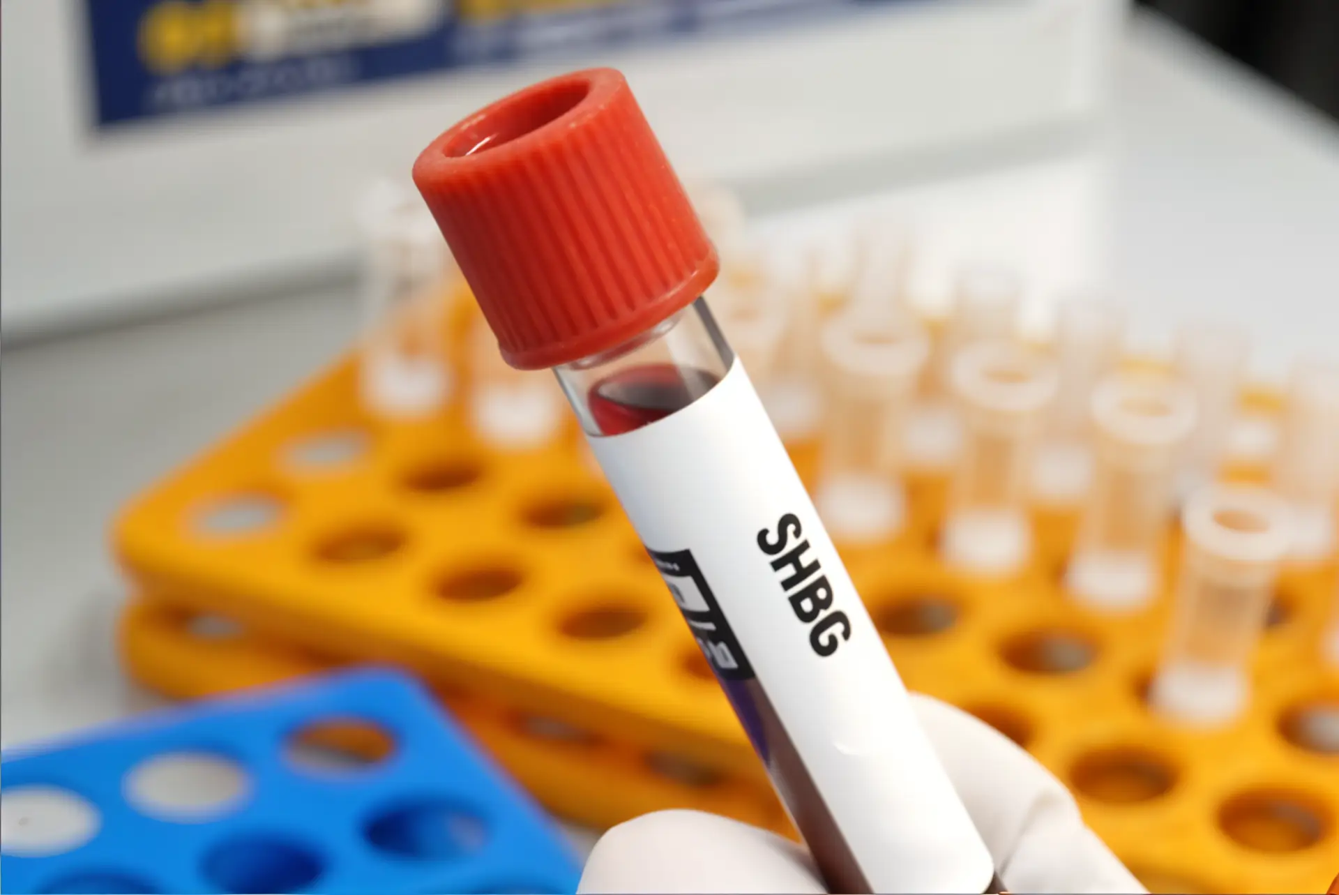 sex hormone binding globulin high
